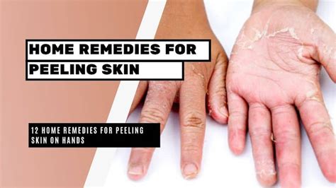 12 home remedies for peeling skin bright freak