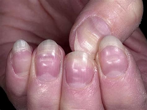 9 Symptoms Of Nails And What They Could Indicate About Your Health