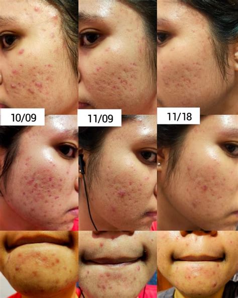 Acne Small Progress For Hormonal Acne Check Comment Section For