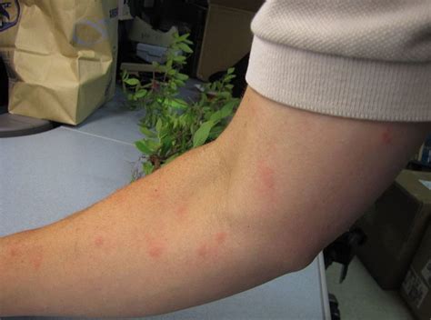 Bed Bug Bites Vs Mosquito Bites Lawnstarter