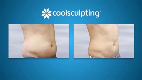 Male Patient Wows With Coolsculpting Before And After Results On