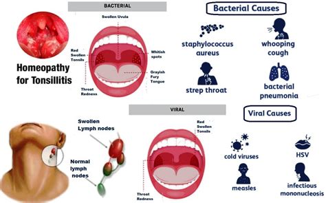 Bacterial Tonsillitis In Adults