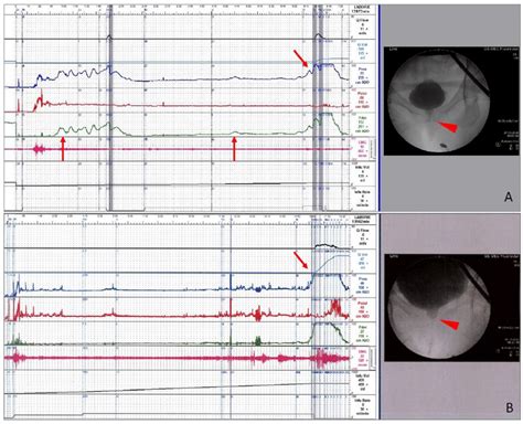 The Characteristic Videourodynamic Tracings In Women With Dysfunctional