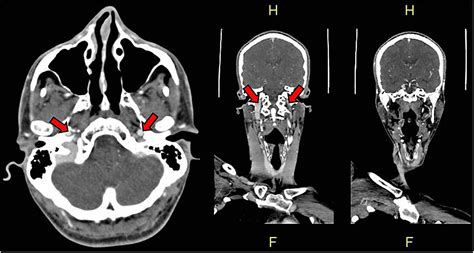Cureus Spontaneous Bilateral Dissection Of The Vertebral Artery A Case Report