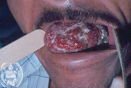 According to astrology, cancer colors are green and blue. tongue cancer | Medical Pictures Info - Health Definitions ...