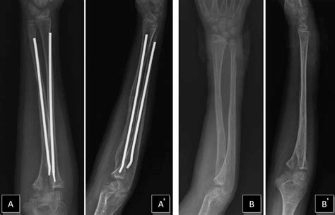 Cureus Pediatric Forearm Refracture With Intramedullary Nail Bending