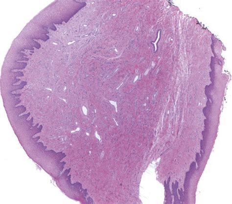 Fibroepithelial Polyp Histology