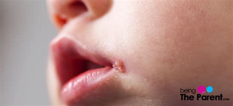 Cold Sores In Babies Symptoms Causes Treatment And Prevention