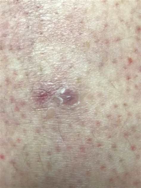 Treatment Of Morgellons Disease With Doxycycline Zhang 2021