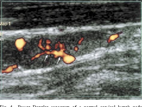 Figure 4 From Sonography Of Neck Lymph Nodes Part Ii Abnormal Lymph