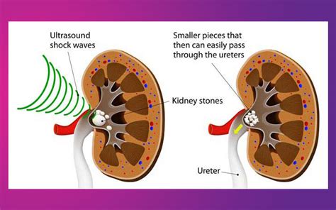 Pcnl Procedure For Kidney Stone Ureteroscopy Laparoscopic Simple