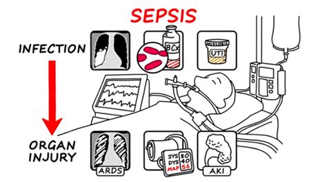 Epas Drawing Down Sepsis Empowering Physician Advisors