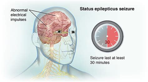Status Epilepticus Johns Hopkins Medicine Health Library