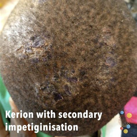Kerion Skin Deep