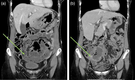 Computed Tomography Ct Of The Abdomen And Pelvis A Ct Imaging At