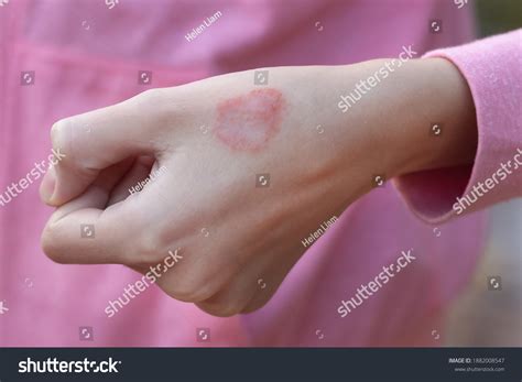 Eczemaatopic Dermatitis On Skin Hand Blurconcept Stock Photo Edit Now