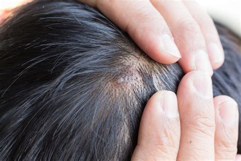 Scalp Psoriasis Symptoms Causes Treatment And Tips