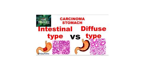 Carcinoma Stomach Intestinal Vs Diffuse Gastric Cancer Pathology