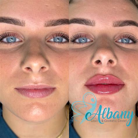 The Russian Lip Technique Albany Cosmetic And Laser Centre
