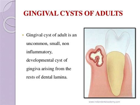 Gingival Cyst Of Newborn Orthodontic Courses By Indian Dental Academ