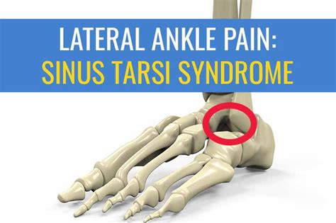 Sinus Tarsi Syndrome As Cause Of Lateral Ankle Pain Sports Injury Physio