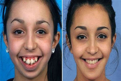 How Can Clear Aligners Change Your Facial Structure SD Align