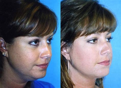 Patient 122406502 Laser Assisted Weekend Neck Lift Before And After