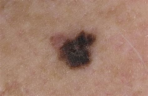 Signs Of Melanoma Pictures 27 Photos And Images