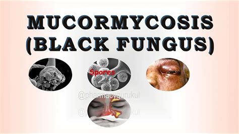 Mucormycosis Black Fungus Youtube
