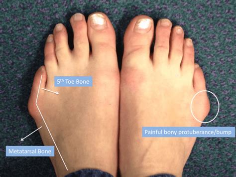 Bunionette Deformity Treatment London Foot Ankle Clinic