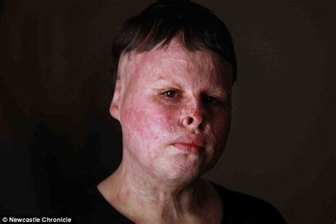 Victim Of Horrific House Fire Has Had Several Skin Grafts But Is Now