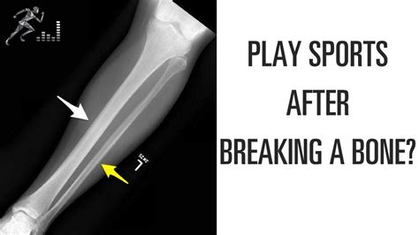 When Can You Play Sports After Breaking A Bone Youtube