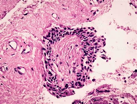 Histology Of Urachal Cyst Photomicrograph Of Histological Stained Slide Showing Urachal Cyst