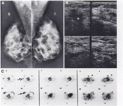 Right Breast Cancer And Axil Lary Metastasis A Mammogram Shows A