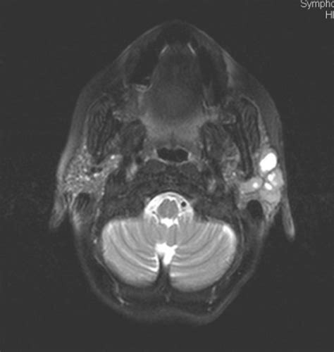 Figure 1magnetic Resonance Imaging With Pathological Correlation In A