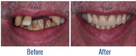Immediate Dentures Borbely Swiss Denture Clinic