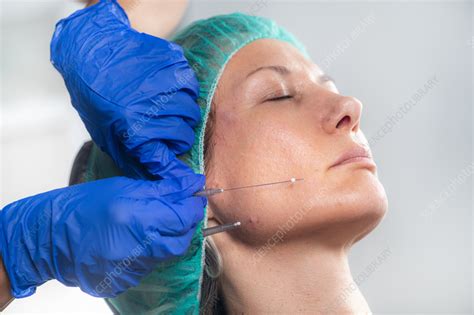 Mesotherapy Thread Face Lift Procedure Stock Image F0365157