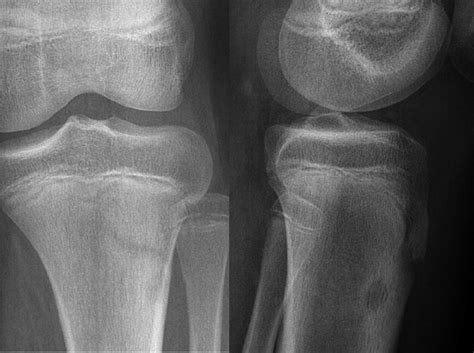 Case Radiograph Of The Knee Showing A Cm Defect In The Lateral Download Scientific