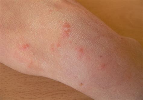 The Complete Guide For Getting Rid Of Scabies Skin And Hair Problems