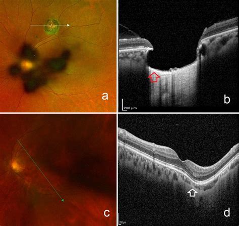 Spectral Domain Optical Coherence Tomography Oct Imaging Features Of