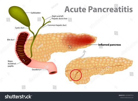 Acute Pancreatitis Caused By Gallstone Gallstones Stock Vector Royalty
