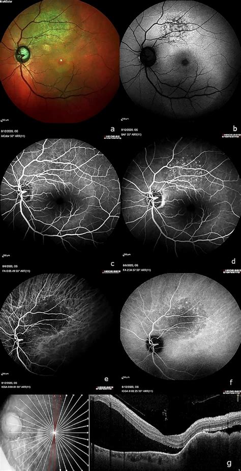Regression Of Choroidal Metastasis From Breast Carcinoma With
