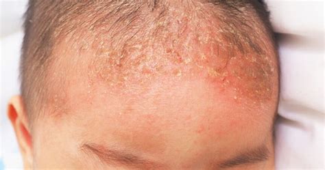 Dermatita Seboreica Simptome Cauze Si Tratament Sam Distribution
