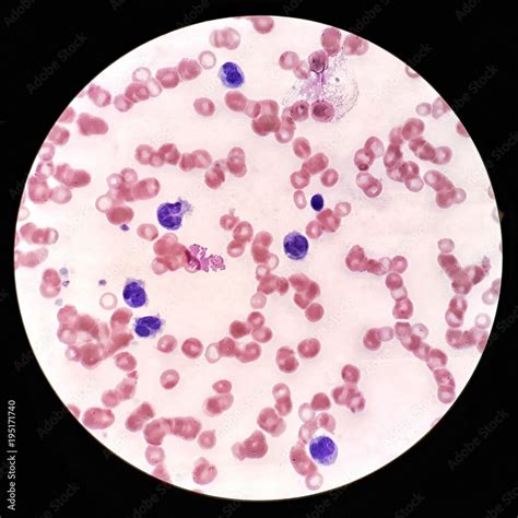 Human Blood Smear Under 100x Light Microscope With Atypical Lymphocytes