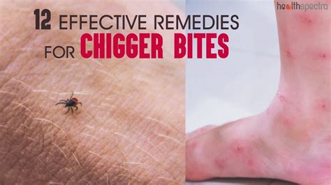 12 Effective Remedies For Chigger Bites Healthspectra Youtube
