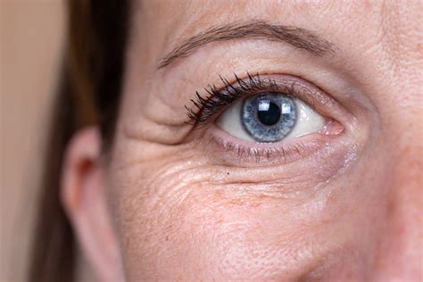 periorbital wrinkles treatments eyebag doctor singapore