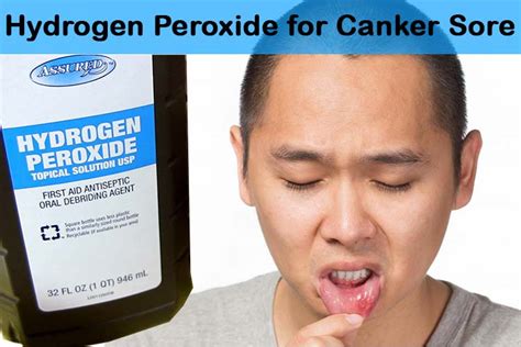 Hydrogen peroxide is a weak base, but even weak bases can do damage (like bleach). El peróxido de hidrógeno para el afta bucal - Ot Toulouse