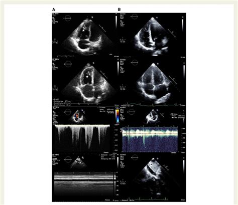 Transthoracic Echocardiogram With Echo Studies Before Treatment