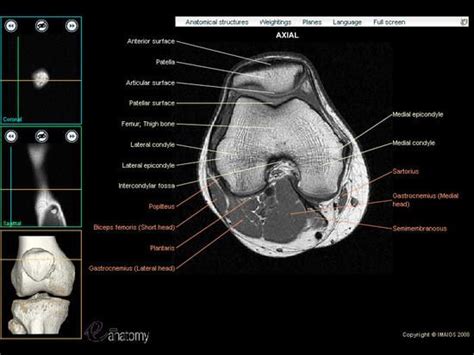 T2w axial fat sat 1. MRI knee - Google Search | Mri, Mri school, Knee mri