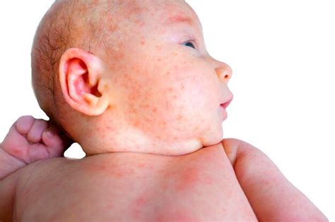 Premium Photo Baby Allergy Skin Food Child Dermatitis Symptom Problem